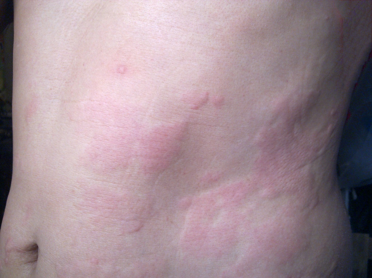 Hives Vs Rash Whats The Difference Between Them